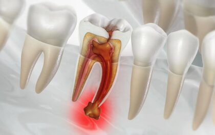 What is a Root Canal on Front Teeth Treatment