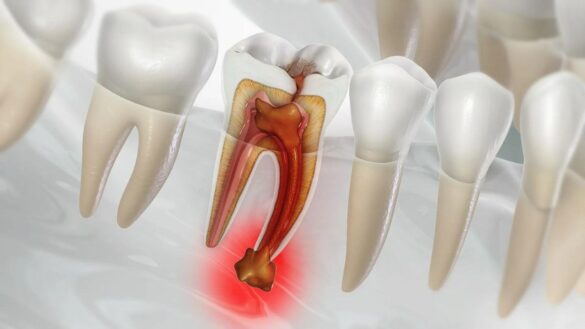 What is a Root Canal on Front Teeth Treatment